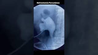 Nefrostomía Percutanea Radiologia Intervencionista [upl. by Bonar]