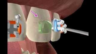 Dental Braces  what is a bracket [upl. by Wiese762]