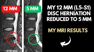 12 mm Disc Herniation Reduced to a 5 mm  12 Weeks of Limitless Transformation [upl. by Assened]