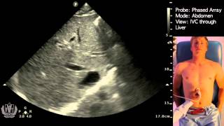 IVC Ultrasound STEP by STEP  Easiest Method [upl. by Franek727]