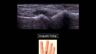 Metacarpophalangeal joint effusion at US [upl. by Dustan]