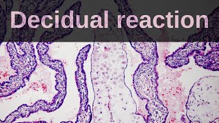 DECIDUALIZATION OF ENDOMETRIOMA IN PREGNANCY [upl. by Gaultiero]