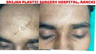 Scar revision surgery  Result after 3 months Scar revision surgery in Ranchi by Dr Pankaj Kumar [upl. by Ralph]