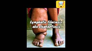 Filariasis fact [upl. by Nnylsoj]