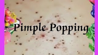 Pimple amp Blackheads Popping  52 [upl. by Baniez]