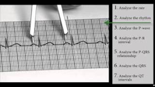 EKG Interpretation and Response SERIES Sinus Dysrhythmias [upl. by Vernice]