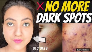 In 7 DAYS  Remove DARK SPOTS ACNE SCARS PIMPLE MARKS amp PIGMENTATION in JUST 7 DAYS  100 RESULTS [upl. by Joashus633]