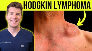 Doctor explains WARNING SYMPTOMS and SIGNS of HODGKINS LYMPHOMA CANCER [upl. by Drageruaeb]