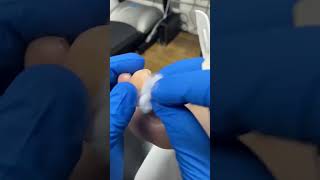 Watch a Podiatrist Expertly Remove a Big Toe Callus with Scalpel [upl. by Connel47]