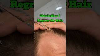 This Is How I Have Been Regrowing My Hair When Fighting Androgenetic Alopecia [upl. by Trepur]