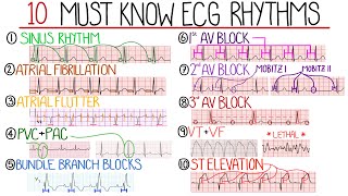 Most Common ECG Patterns You Should Know [upl. by Suiraj]