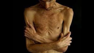 Anorexia Nervosa Signs Symptoms Causes Treatment [upl. by Aidahs]