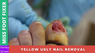 Stubborn Fungal Nail Removal  Miss Foot Fixer  Marion Yau [upl. by Erdied]