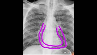 3 signs of pneumopericardium on chest xray  air around the heart on chest xray  youtubeshorts [upl. by Torrell255]