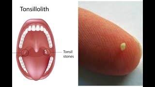 Tonsilloliths tonsil stones a patient education video by Carlo Oller MD [upl. by Takken811]