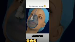 Blepharoplasty surgery 😳youtubeshorts ytshorts trendingshorts [upl. by Nossaj]