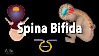 Spina Bifida Animation [upl. by Nevins325]