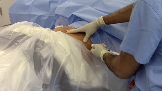 Lipogems Procedure in a Knee Arthroscopy Raj Pandya MD Atlanta Orthopaedic Institute [upl. by Haikan]