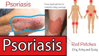 Psoriasis Symptoms and Treatment Everything you need to know about Psoriasis [upl. by Neural917]