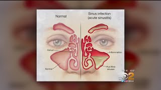 Doctor Tried And True Methods For Sinus Relief Are Still Best [upl. by Jehoash]