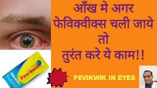 अगर आँख मे फेविक्वीक्स चली जाये तो क्या करेंतुरंत आराम कैसे पायेंFevikwik in eyes treatment [upl. by Thier58]