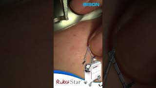 BISON MEDICAL RUBY STAR TREATMENT [upl. by Swart]