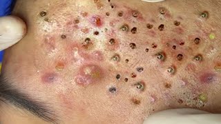 Big Cystic Acne Blackheads Extraction Blackheads amp Milia Whiteheads Removal Pimple Popping  6524 [upl. by Michell]