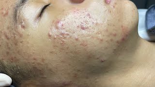 ACNE TREATMENT VU QUYNH MI  Perennial Blackheads On Boy Face 2024FULL [upl. by Wiles661]