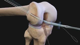 Arthrex ACL Reconstruction [upl. by Lerret]