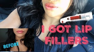 MY FIRST TIME JUVEDERM VOLLURE LIP FILLERS [upl. by Enial370]