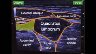 Quadratus lumborum block intramuscular approach [upl. by Ennaitsirhc]