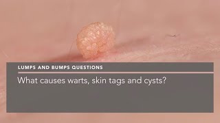 What causes warts skin tags and cysts [upl. by Helas]