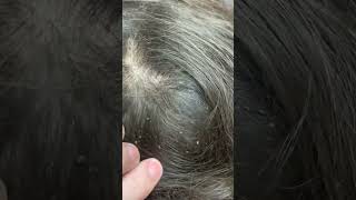 Picking a thousand of lice on hair How to get rid of lice licetok nits piojos kuto kutu lice [upl. by Selden]