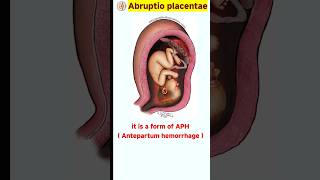 what is abruptio placenta  placental abruption  shorts [upl. by Narhem]