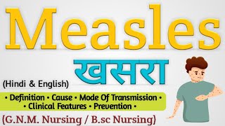 Measles खसरा  Measles Disease In Hindi [upl. by Yreva]