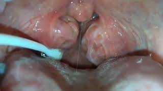 How to remove caseum from your tonsils [upl. by Jelle]