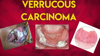 VERRUCOUS CARCINOMA [upl. by Tildi]