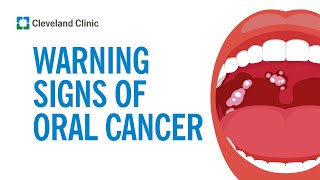 How to Screen Yourself for Oral Cancer [upl. by Michele542]