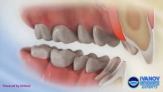 Teeth Before and After Overbite Fix with Braces [upl. by Donni394]