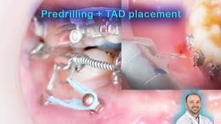 Predrill a pilot hole to insert a screw into dense mandible bone penetrate the hard cortical bone [upl. by Sammy]