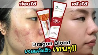 เจลแต้มสิวเทพๆ สิวหายจริงไม่โป๊ะแตก Dragon Blood Anti Acne  Scar Gel มันดีอ่ะ  Happy Yammy Story [upl. by Sharma]