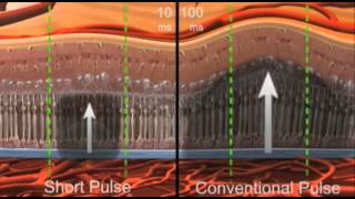 PASCAL  Pattern Scanning Laser introduction [upl. by Redford]