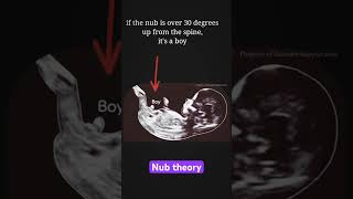 Guess the gender with Nub theory Baby boy or girl pregnancy ultrasound pregnancycare [upl. by Ketty213]