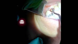 Simple Premolar Extraction using 962 Forceps Woodson and Bernard Spade Elevators drwahan [upl. by Assenna]