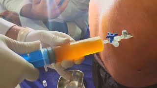 Thoracentesis procedure  Remove pleural effusion [upl. by Evangelin]