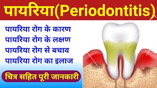 पायरिया periodontitis  periodontitis Causes Symptoms Diagnosis Treatment  payriya rog  bio [upl. by Cinimod]