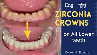 How teeth capping is done  zirconia crowns  Dental crowns  कैपिंग कैसे की जाती है [upl. by Tat]