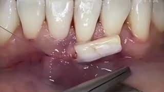 chirurgie muccogingivale type greffe conjonctive enfouie trt dune récession gingivale cl 2 [upl. by Tatman818]