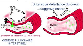 Oedème aigu pulmonaire [upl. by Burnard295]