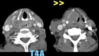 TMT Laryngeal cancer imaging by Dr Abhishek Mahajan [upl. by Arres]